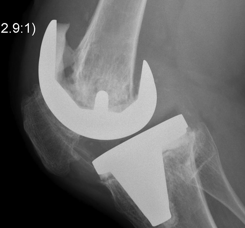 Revision TKR Deficient Femoral Metaphysis